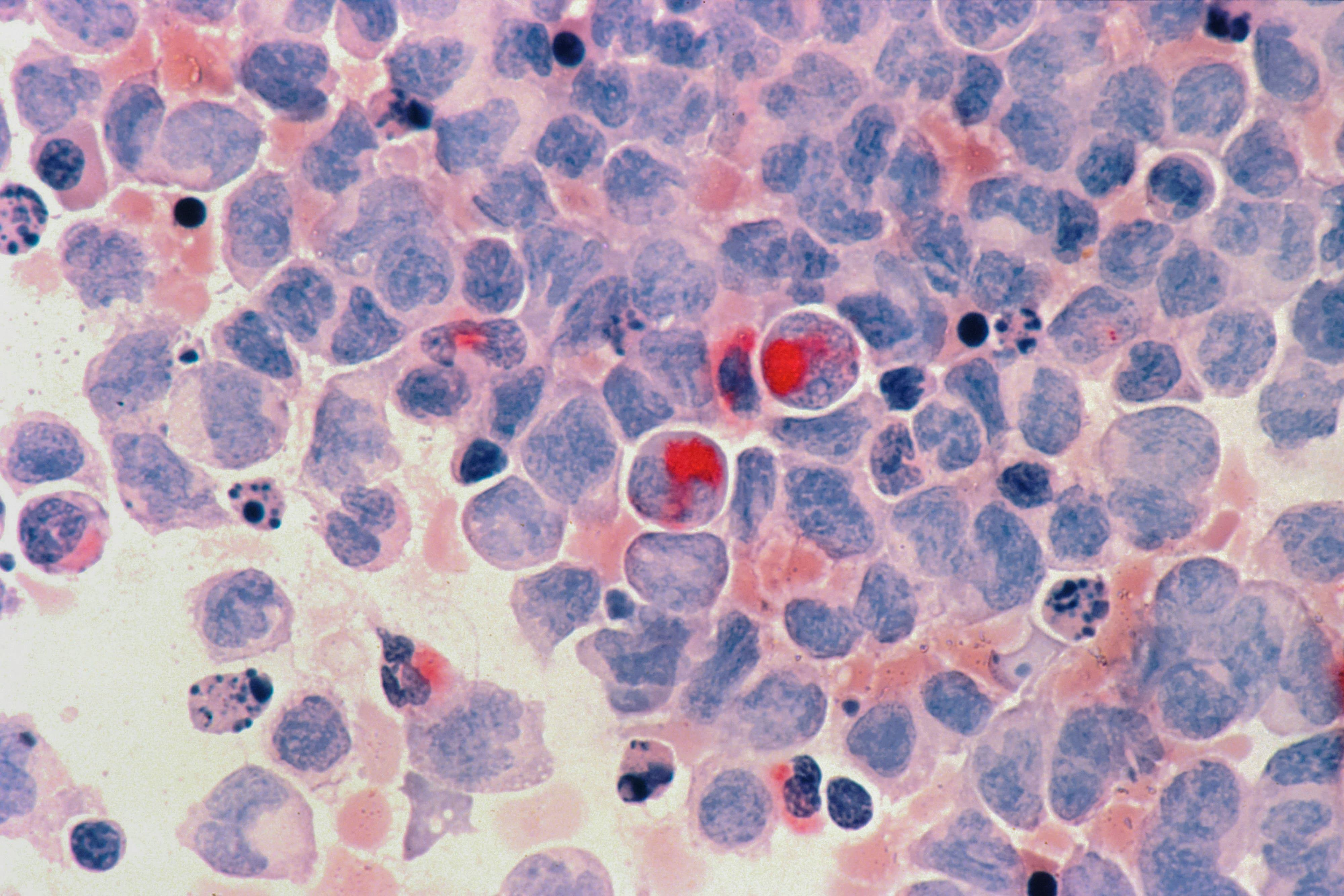 Détecter le cancer des années avant l’apparition de la maladie